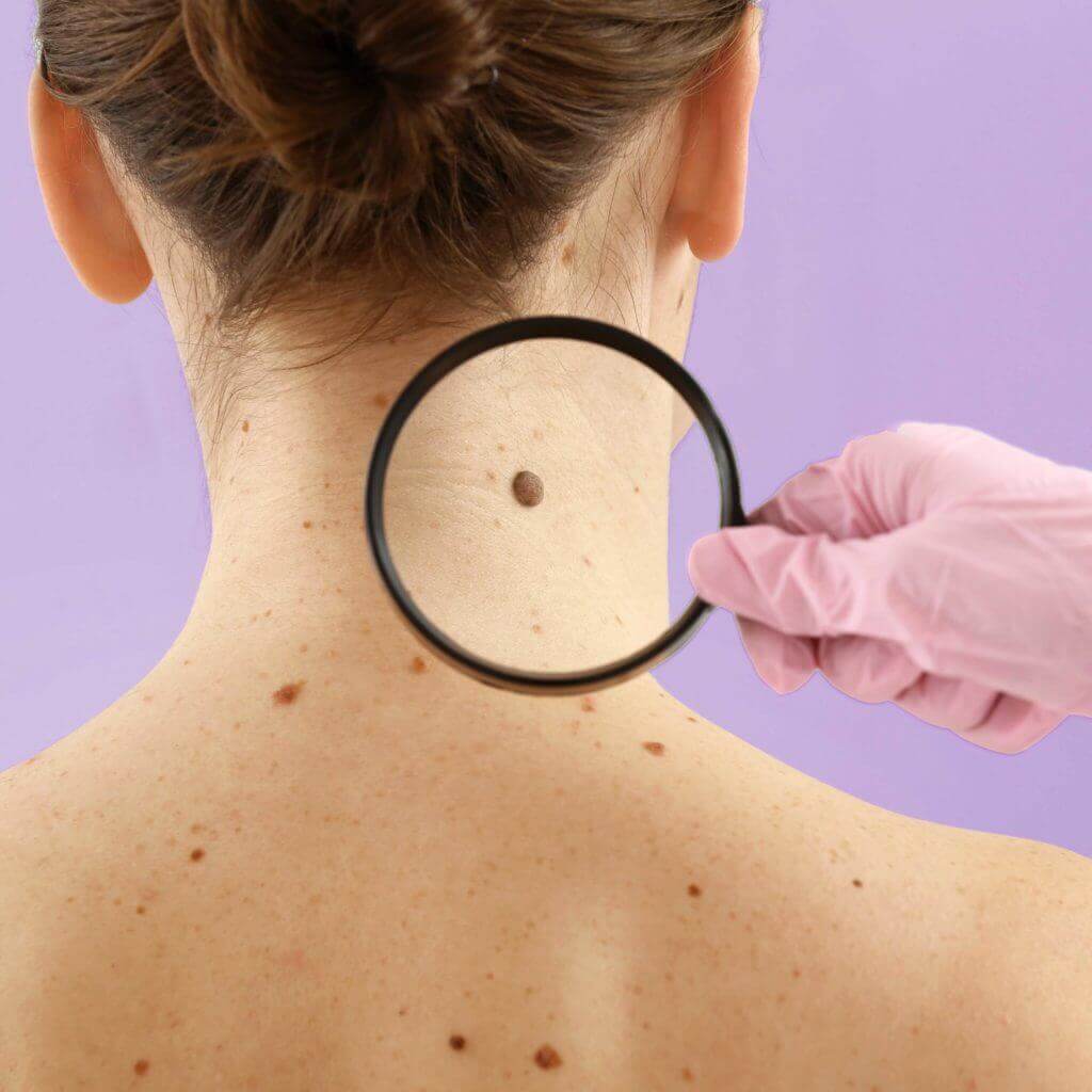 Skin Cancer: what you should know.